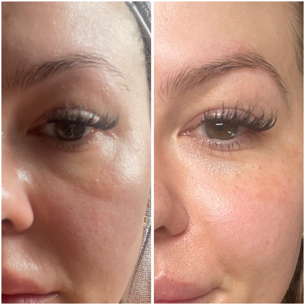 The Wand 4i1 + hyaluronate water 