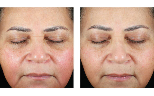 TRIO LUXE - på lager skal bestilles på mail 